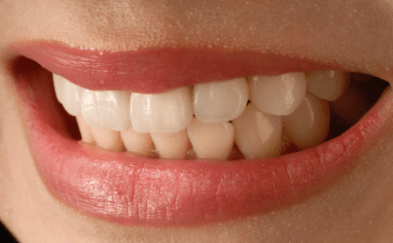 Endodontic Therapy Anterior Tooth: A Practical Guide - Biocrede Endodontics