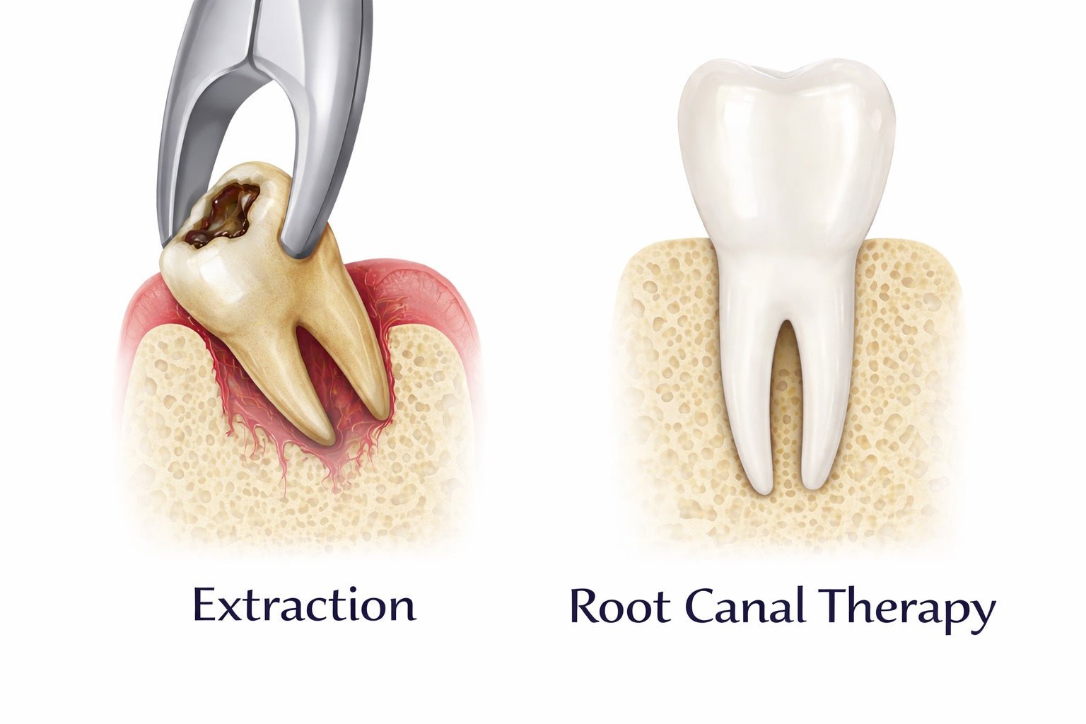 Root Canal vs Extraction: Root Canal or Pull Tooth - Biocrede Endodontics